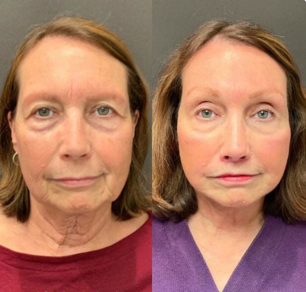 Rejuvenecedor - Palp Lifting Invisible Aurora-Real 