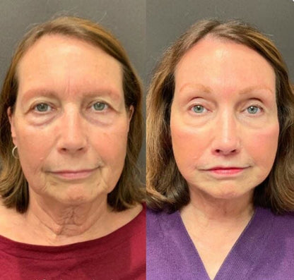 Rejuvenecedor - Palp Lifting Invisible Aurora-Real 